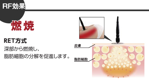 RF効果:燃焼 RET方式 深部から燃焼し、脂肪細胞の分解を促進します。