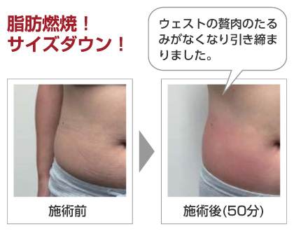 脂肪燃焼!サイズダウン!「ウエストの贅肉のたるみがなくなり引き締まりました。」