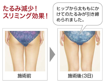 たるみ減少!スリミング効果!「ヒップから太ももにかけてのたるみが引き締められました。」