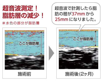 超音波測定!脂肪層の減少!「超音波で計測したら脂肪の層が37mmから25mmになりました。」
